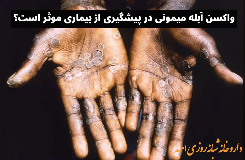 واکسن آبله میمونی